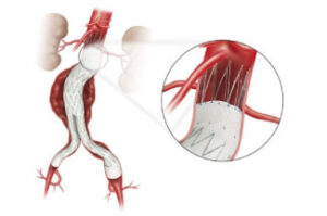 Interventional Radiology Procedures | Minimally Invasive Treatments