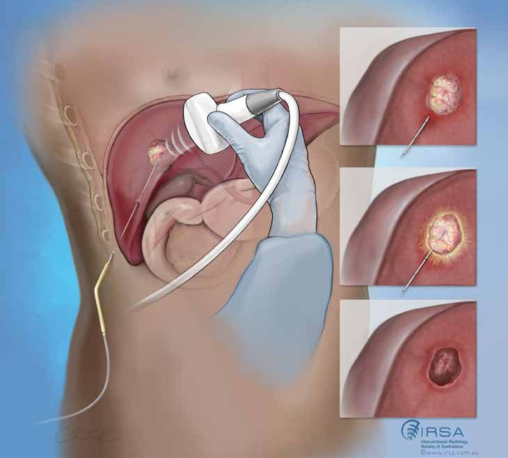 IMAGE GUIDED TUMOUR ABLATION