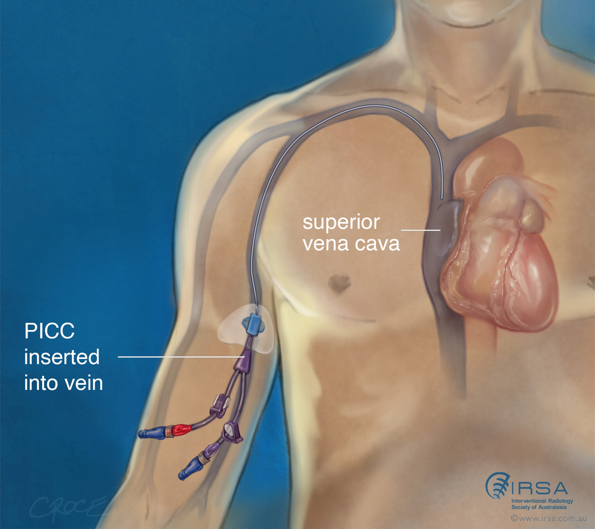 Cath ter Picc Line Picc Line Voie Centrale HEQXD Cath ter Picc Line Picc Line Voie Centrale HEQXD
