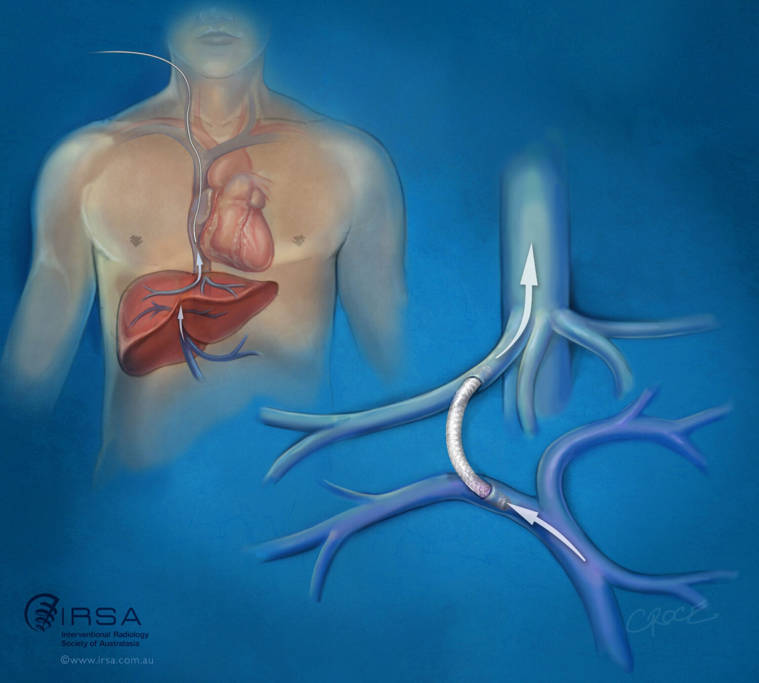 Transjugular Intrahepatic Portosystemic Shunt (TIPS) | IRSA