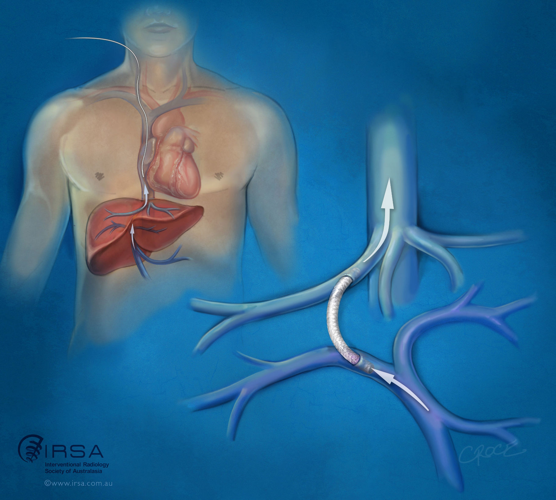 Transjugular Intrahepatic Portosystemic Shunt (TIPS) | IRSA